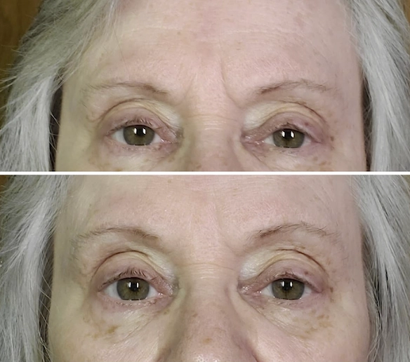 More Women Are Choosing Needle-Free Skincare