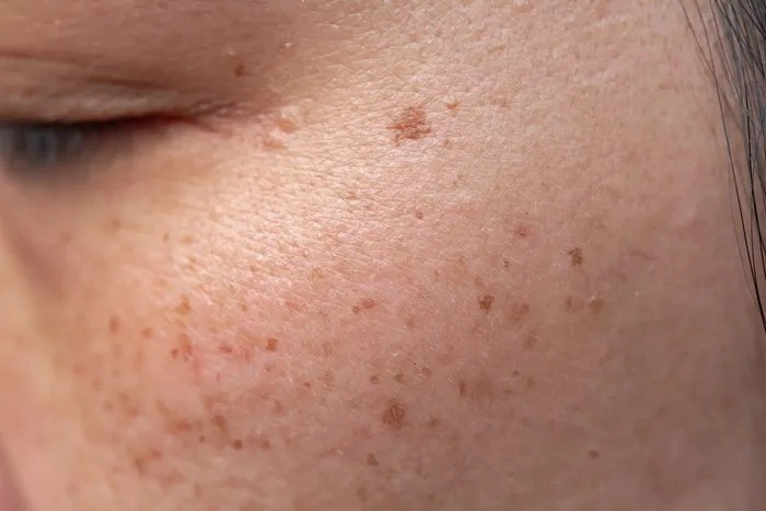 Those spots aren't freckles. Here's why that changes everything about how you treat them.