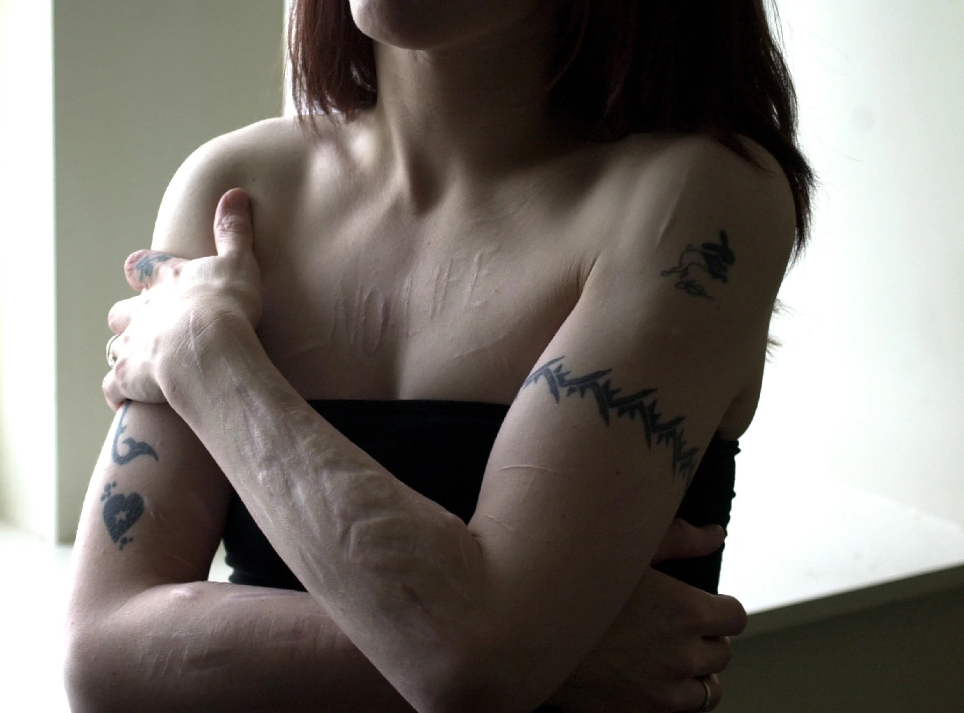 5 Reasons Your Self-Harm Scars Can Still Fade, Even After 5, 10, or 15 Years
