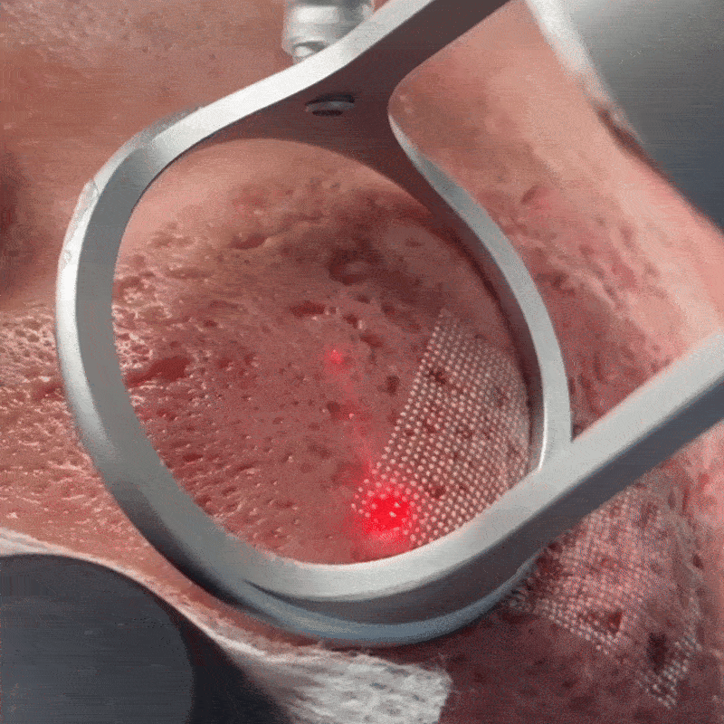 Skip The Laser Treatments For This Gentler Alternative