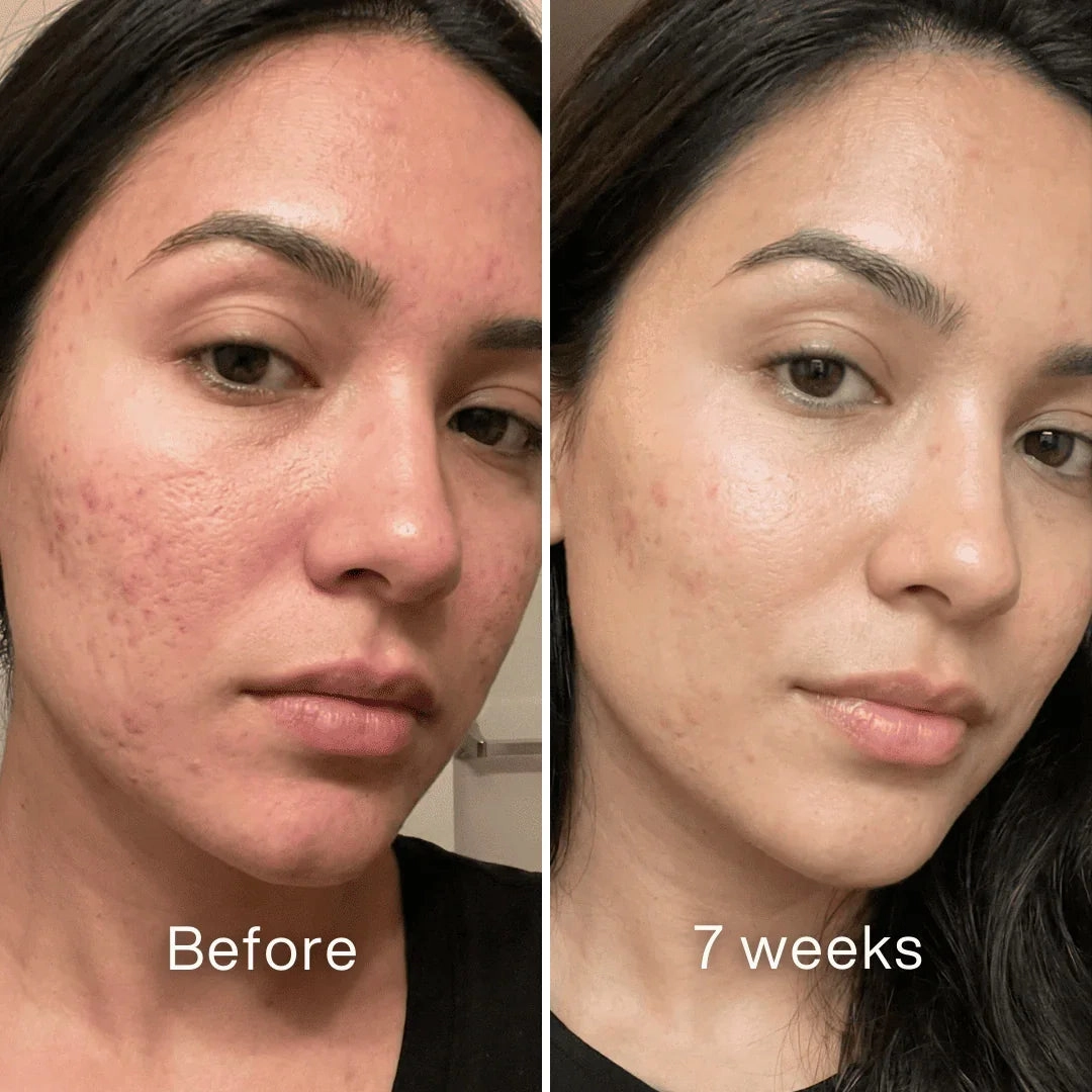 Restoring My Skin Texture With Zero Risk