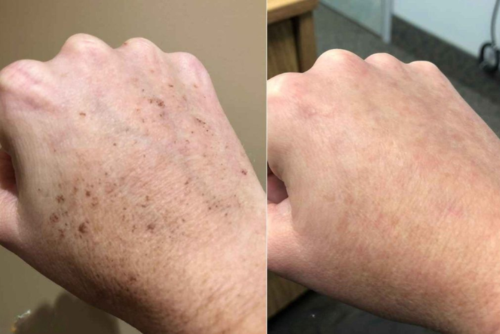 Age Spots Are Telling Your Age