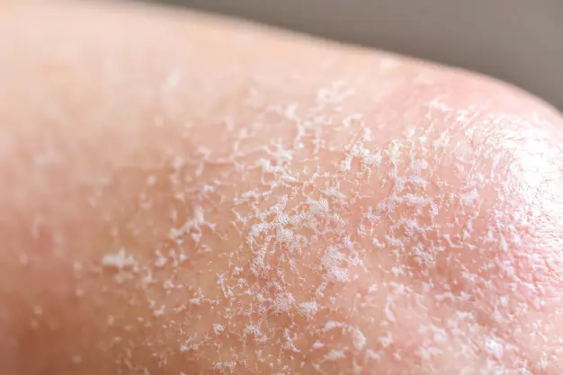 Tight, Dry or Irritated Skin