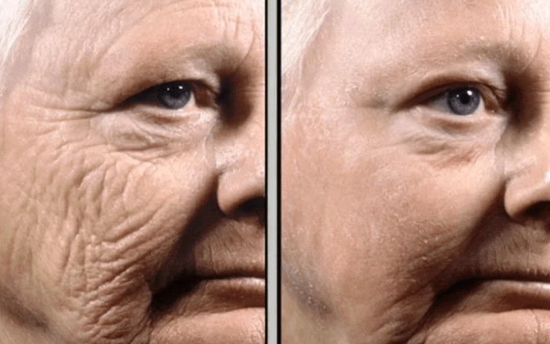 Rétinol — Résultats cliniques