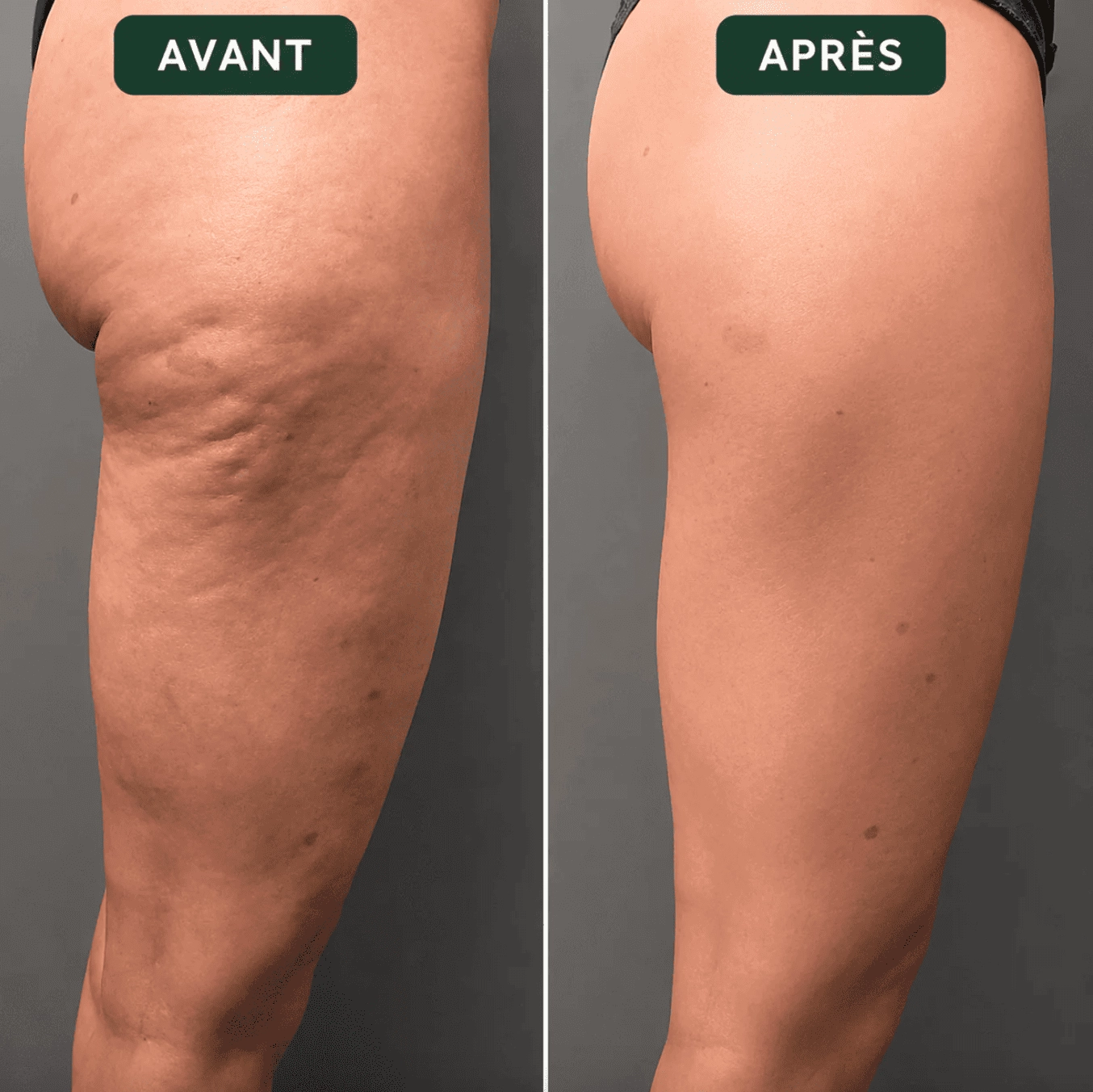 Regardez Votre Corps Passer de “Gonflé et Lourd” à “Léger et Définis”
