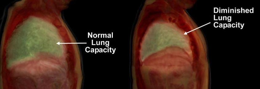 Add Up To 500 ml Of Lung Capacity