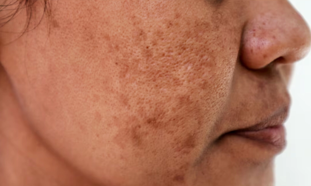 Post Inflammatory Pigmentation