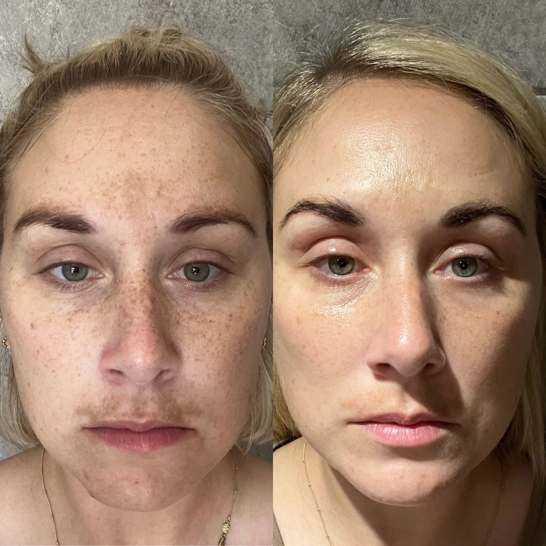 I Spent Thousands On Skincare That Did Nothing For My Pigmentation. Then I Found Two Products That Actually Changed My Skin.