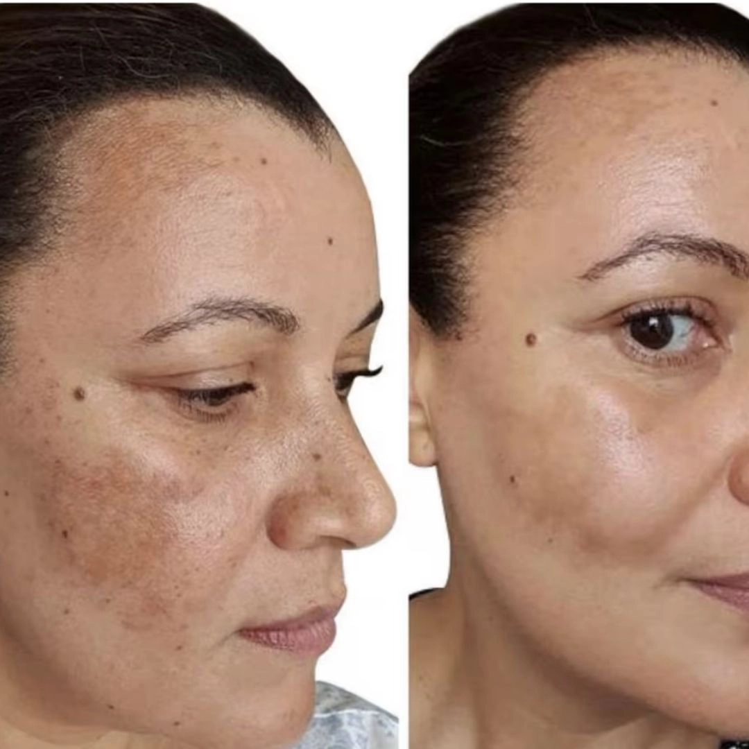 WHAT IS PIGMENTATION & AGE SPOTS?