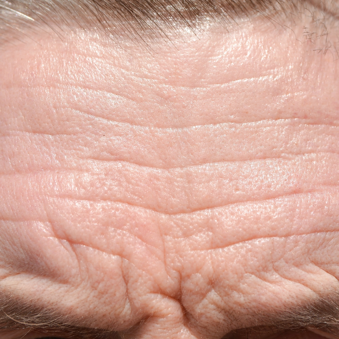 Fine Lines & Wrinkles