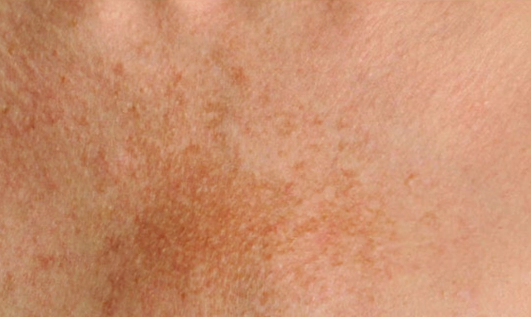 Melasma