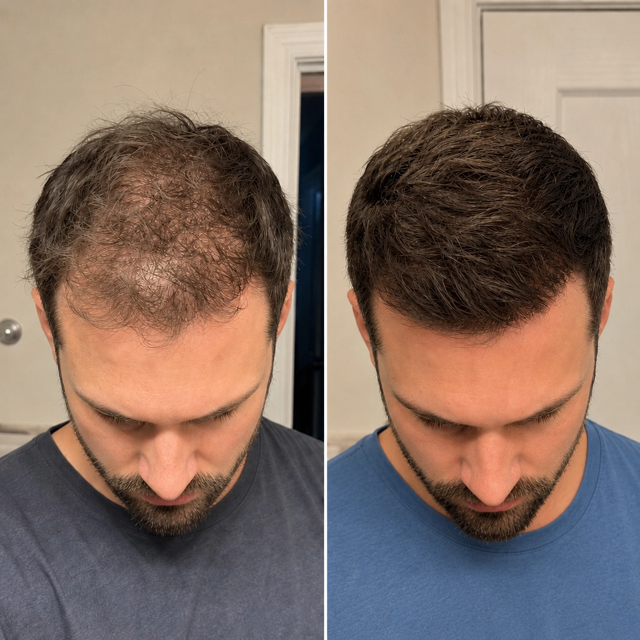 5 Reasons Why Men Across the UK Are Taking This Tasty Gummy for Their Hair
