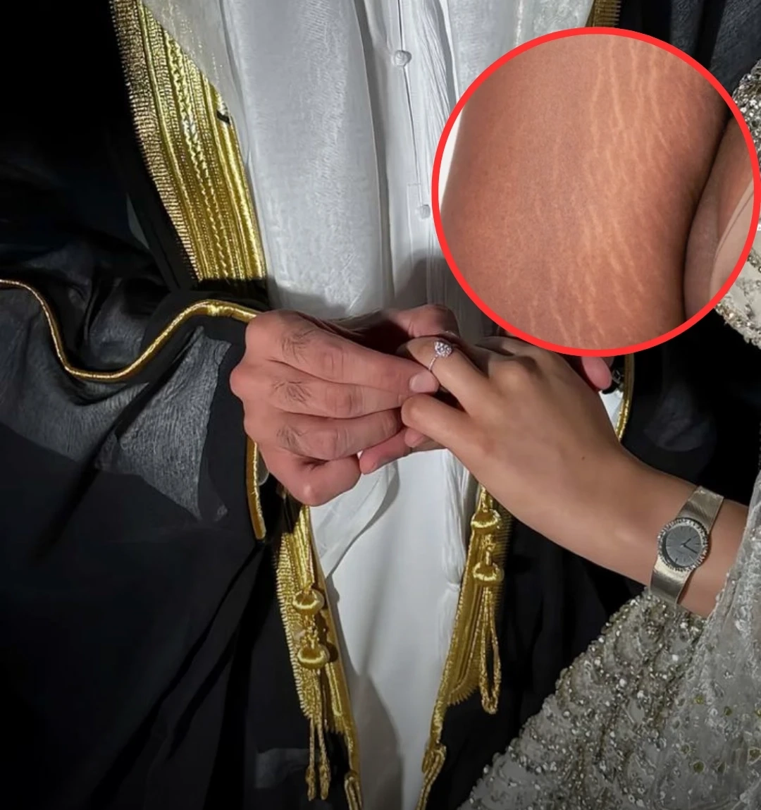 سبعة حقائق عن السيلوليت يجب لكل عروس معرفتها قبل تفصيل فستان الزفاف