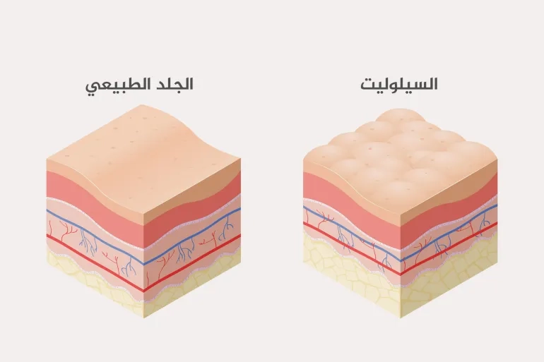 السيلوليت ليس مرتبطاً بزيادة الوزن فقط