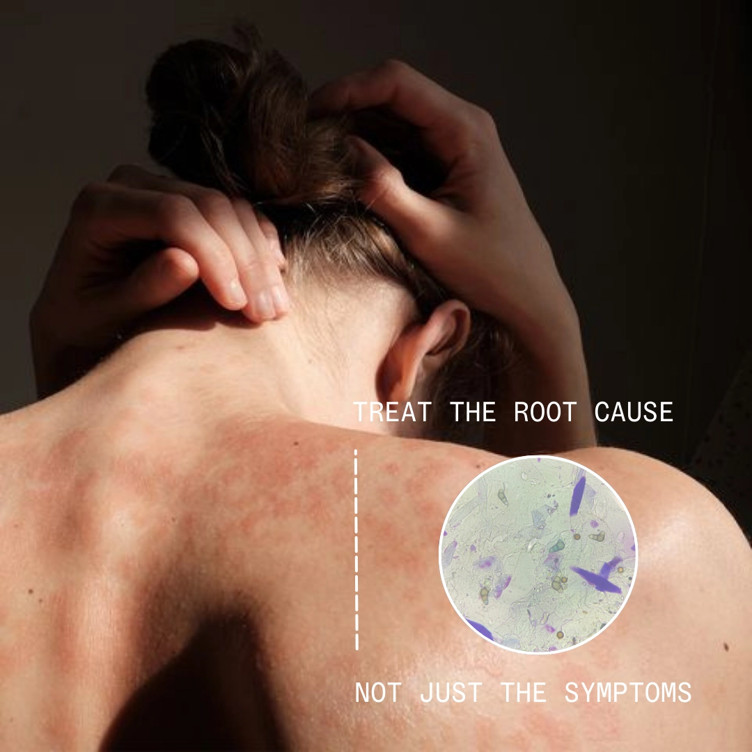Steroid creams suppress. They don't solve.&nbsp;