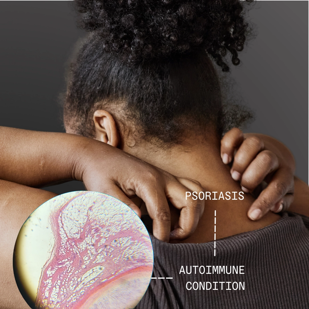 Your psoriasis was never a skin condition to begin with